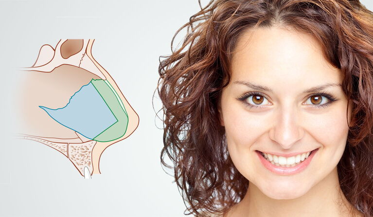 Eine schiefe oder verkrümmte Nasenscheidewand behindert die normale Nasenatmung.Sie stellt mitunter ein gravierendes gesundheitliches Problem dar. Wir haben die chirurgische Kompetenz der Septorhinoplastik in Kombination mit der ästhetischen Nasenkorrektu