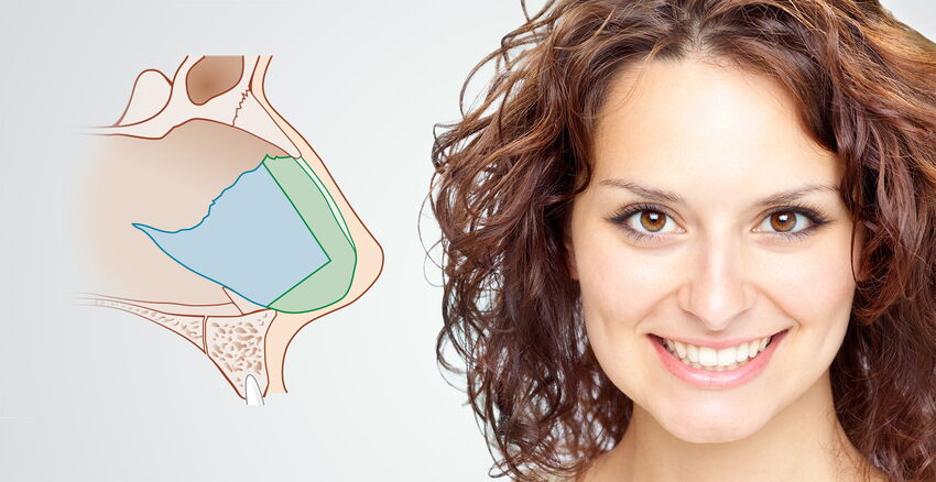 Septorhinoplastik: Nasenscheidewandkorrektur - Septumplastik & ästhetische Nasenkorrektur - die Rhinoplastik in einer OP.