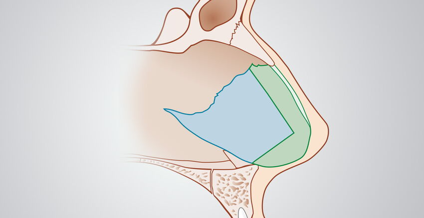 Nasenscheidewandkorrektur oder Septumplastik