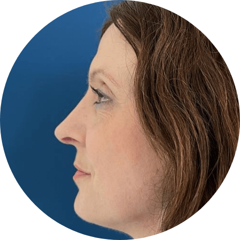 Nachherfoto nach erfolgreicher Nasen-OP