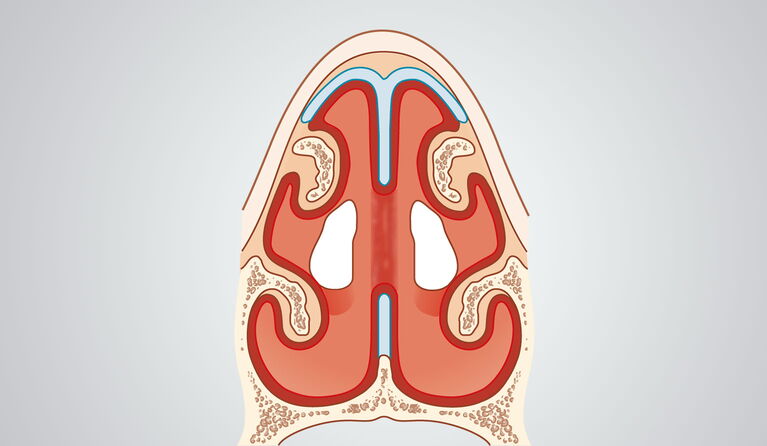 Septumperforation Teaserbilder