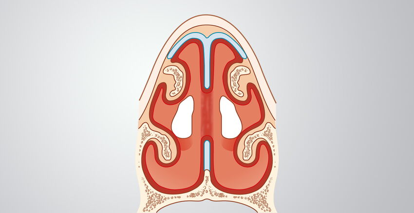 Septumperforation Headerbild