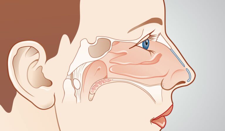 Teaserbilder zu Spezielle Nasenchirurgie - erweiterte Nasennebenhöhlenchirurgie
