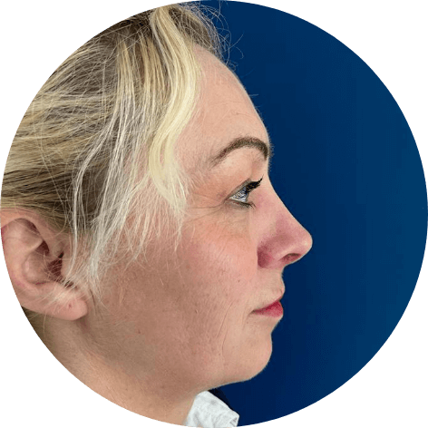 Nachherfoto nach erfolgreicher Nasen-OP