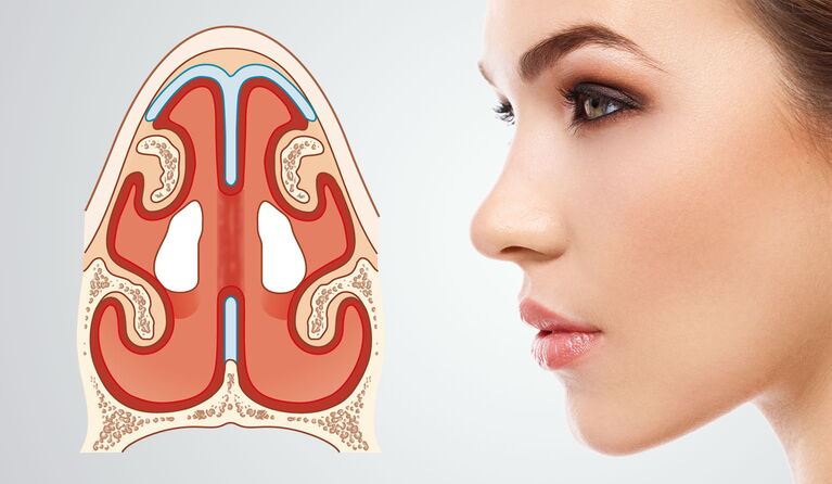Wenn die Nasenscheidewand ein Loch hat, sorgt das bei fortschreitender Größe des Lochs für erhebliche Probleme. Mit dieser Nasen-OP können wir Sie fachärztlich versorgen. Auf Wunsch können im Rahmen einer Septorhinoplastik auch ästhetische Wünsche berücks