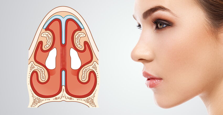 Der Verschluss eines Lochs in der Nasenscheidewand lässt sich mit der ästhetischen Nasenkorrektur verbinden.