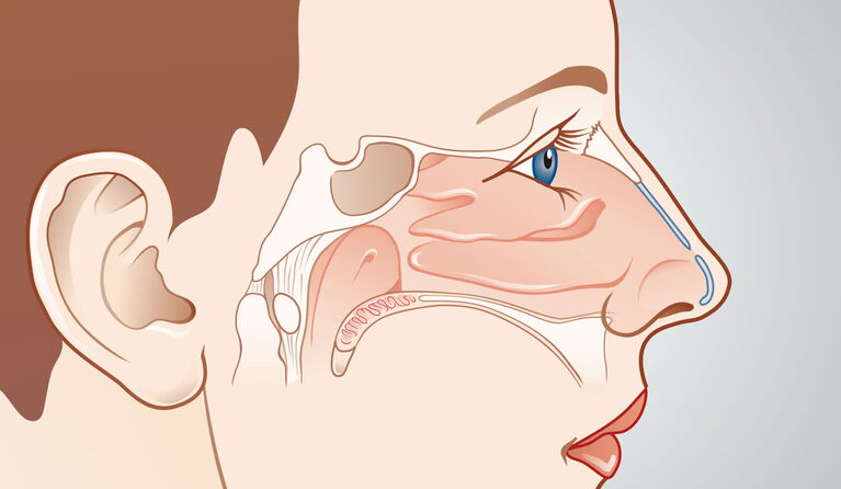 Teaserbilder zu Spezielle Nasenchirurgie - erweiterte Nasennebenhöhlenchirurgie