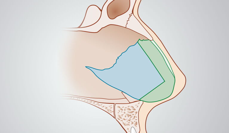 Dieses Schema stellt eine Nasenscheidewandverkrümmung dar. Eine Krümmung oder Veränderung der Nasenscheidewand kann die freie Atmung stark beeinträchtigen. Die Nasenscheidewandkorrketur als Nasenkorrektur der inneren Nase, schafft Abhilfe.